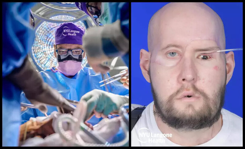 ABŞ-də dünyada ilk tam göz transplantasiyası həyata keçirilib: Əməliyyatda 140 tibb işçisi iştirak edib