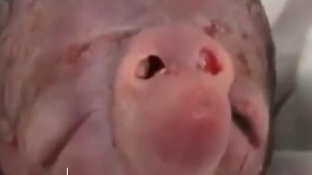 Bakıda ağzı olmayan uşaq dünyaya gəldi - VİDEO