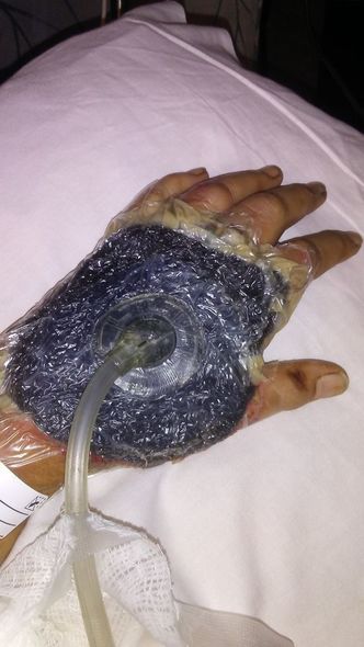 Qutunu açanda ölümcül infeksiyaya yoluxdu - FOTO