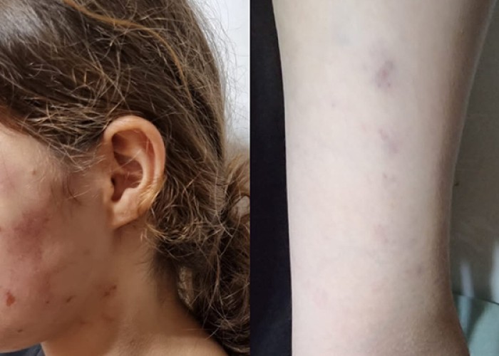 Lənkəranda məktəbli qızın döyülməsi ilə bağlı cinayət işi başlanıldı