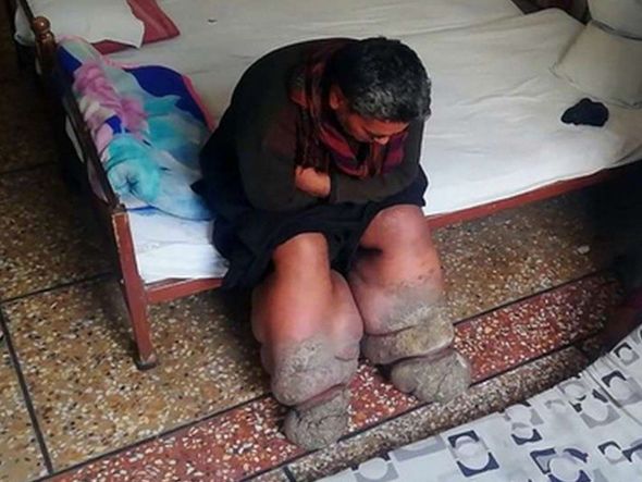 Yayılmasının qarşısı alınan yeddi yoluxucu xəstəlik 