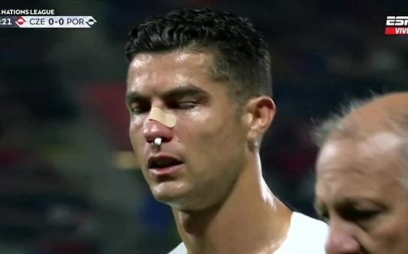 Ronaldu rəqib qapıçı ilə toqquşmadan sonra ciddi xəsarət aldı - FOTOLAR