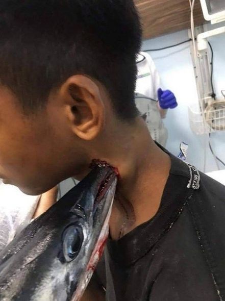 Sudan tullanan balıq oğlanın boynunu deşdi - FOTO