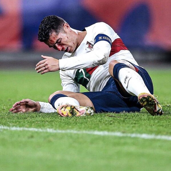 Ronaldu rəqib qapıçı ilə toqquşmadan sonra ciddi xəsarət aldı - FOTOLAR