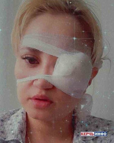 İtin dişlədiyi qadın gözünü itirmək təhlükəsi ilə üzləşdi - ANBAAN VİDEO