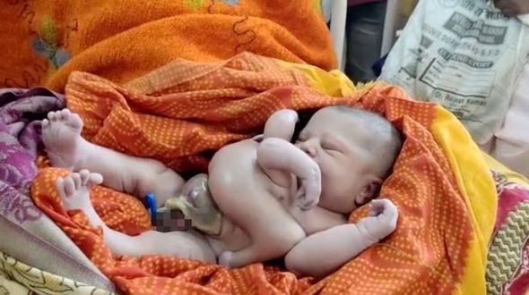 Hindistanda dörd əli və dörd ayağı olan uşaq doğulub - FOTO