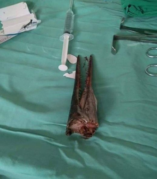 Sudan tullanan balıq oğlanın boynunu deşdi - FOTO