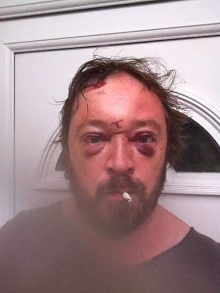 İçki düşkünü olan şəxs selfidən sonra başına gələnləri görüb içməyi atdı
