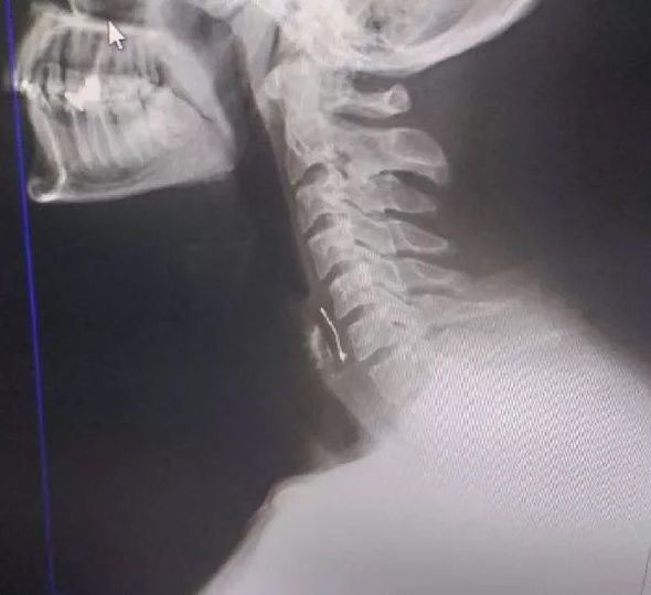 Dostunun ad günündə yediyi tort boğazında ömürlük iz qoydu - FOTO