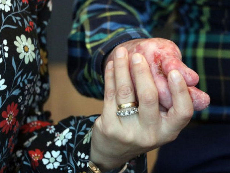 10 il sonra ilk dəfə arvadının əlini tuta bildi - Dəhşətli "kəpənək xəstəliyi" - FOTO
