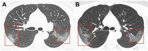 Çin həkimləri koronavirusa yoluxmuş xəstənin ağciyərlərinin görüntülərini yaydılar - FOTO