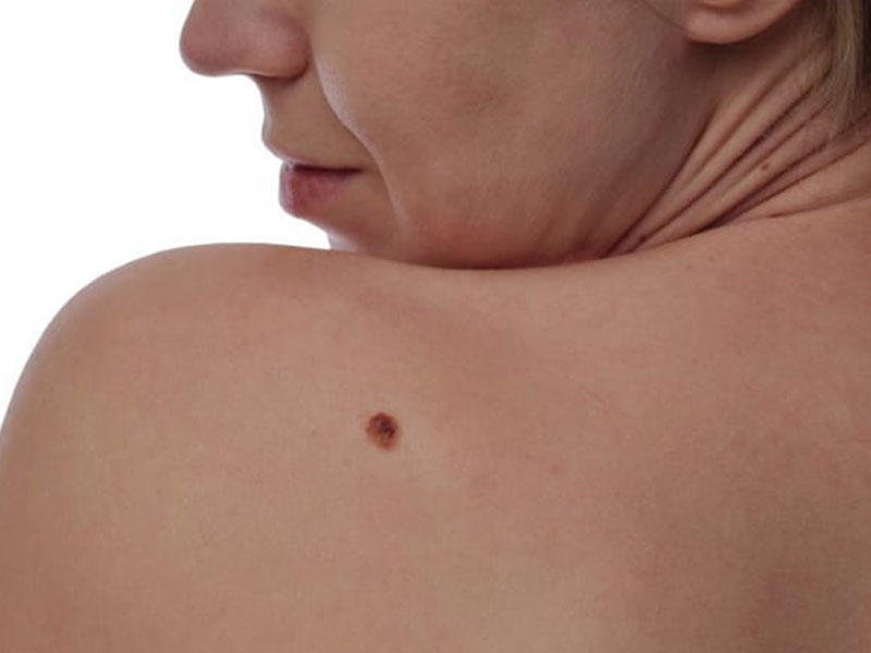 Həkim-dermatonevroloq: Melanoma daha çox qadınlarda rast gəlinir