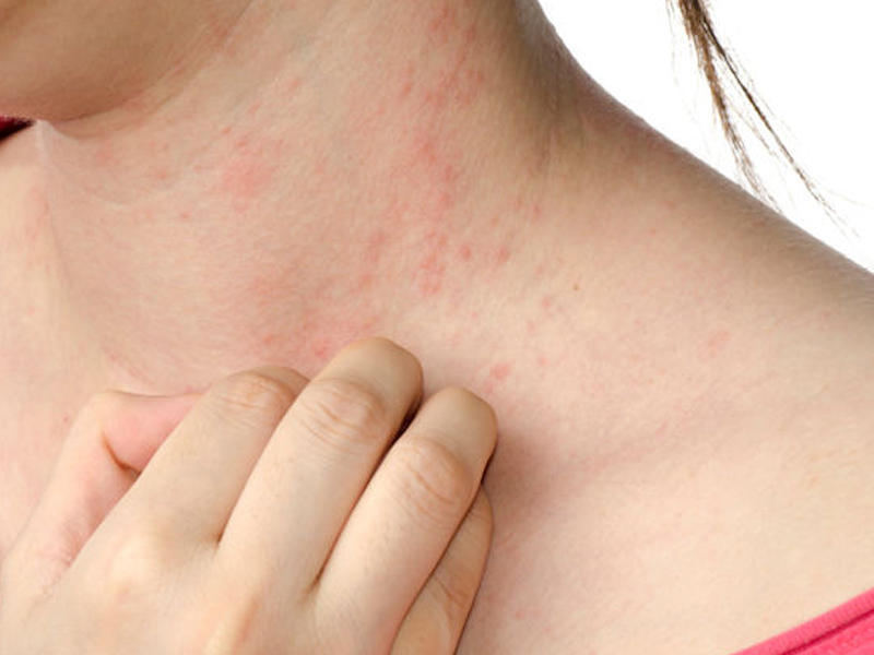 Dermatoloqlar koronavirusun daha bir simptomunu aşkar ediblər