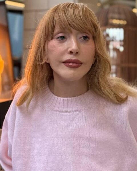 Alla Puqaçova tanınmaz halda - FOTOLAR