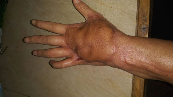 Qutunu açanda ölümcül infeksiyaya yoluxdu - FOTO