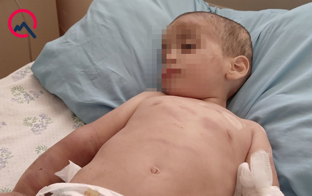 Ağdamda valideyn işgəncəsinə məruz qalan körpənin vəziyyəti AÇIQLANDI