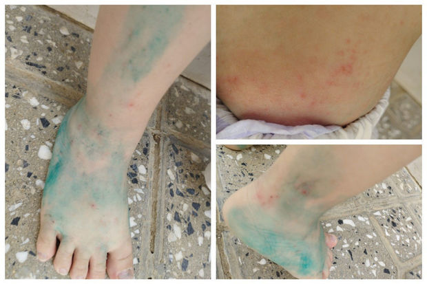 TƏBİB-dən sığınacaqdakı uşaqlar arasında yayılan dəri xəstəliyi barədə AÇIQLAMA