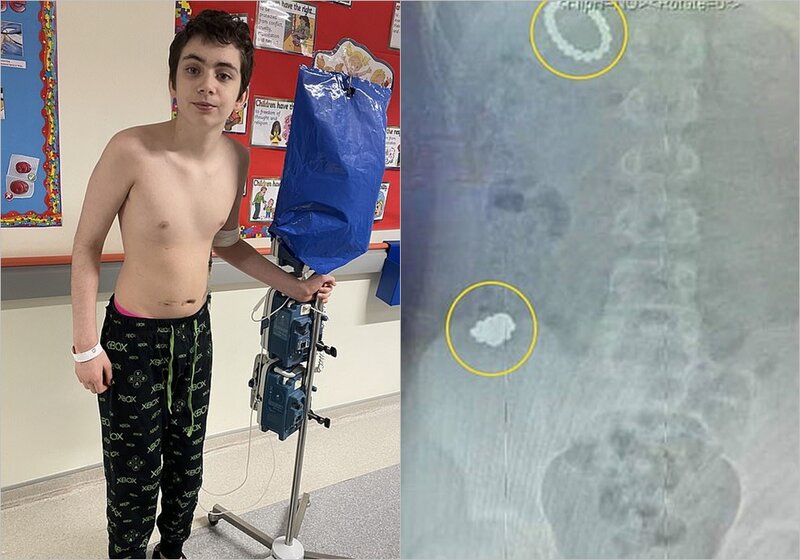 Maraq üçün 54 oyuncaq maqniti uddu, ölümdən döndü - FOTO/VİDEO