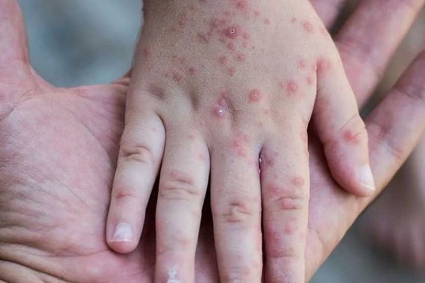 ÜST Avropada qızılca epidemiyasının səbəbini açıqladı