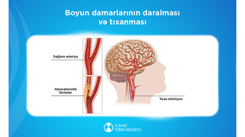 Bu müalicə də icbari tibbi sığortaya daxildir