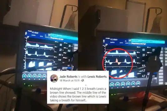 "Ölmüş" gənc orqanları bağışlandıqdan sonra "dirildi" - FOTO/VİDEO